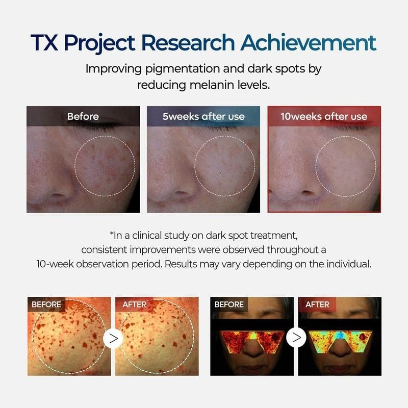 🔥𝙇𝙞𝙢𝙞𝙩𝙚𝙙-𝙏𝙞𝙢𝙚 𝙊𝙛𝙛𝙚𝙧 |TX Cream 50ml｜Nano-sized Tranexaminc Acid for Dark Spots & Hyperpigmentation